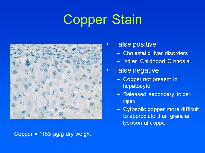 Copper Stain False positive  Cholestatic liver disorders Indian Childhood Cirrhosis False negative Copper